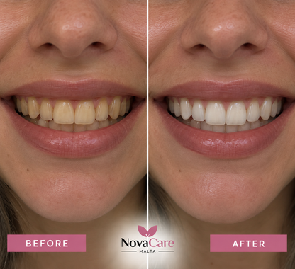 Novacare LED Light Teeth Whitening kit